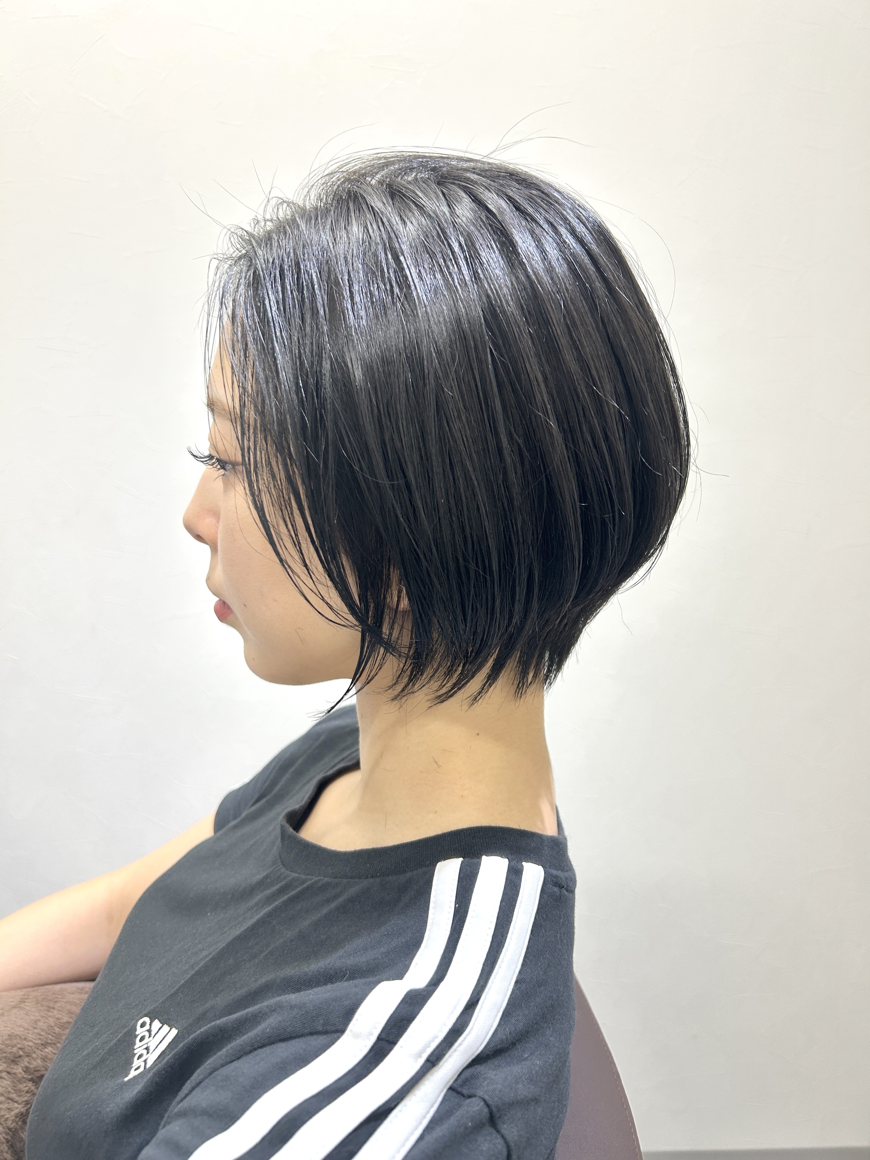 丸み矯正施術後